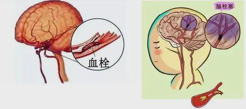 腔隙性脑梗塞,腔隙性脑梗塞吃啥药最好