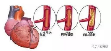 冠心病的定义与成因