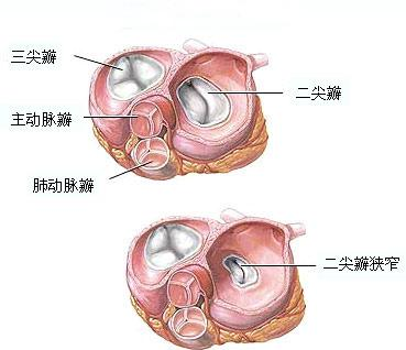 风湿性心脏病,风心病的最佳治疗方法