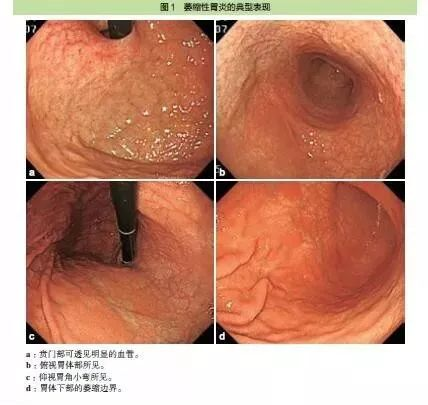 慢性萎缩性胃炎,慢性萎缩性胃炎吃什么食物最养胃