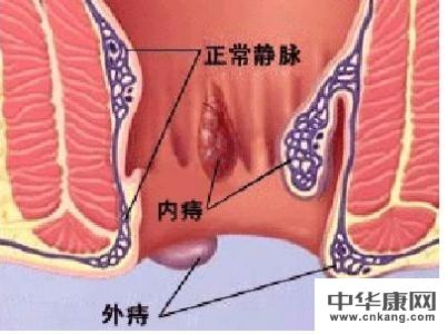 治痔疮的药哪种最好,肛门长了个肉球是什么东西