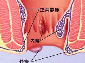 药物治疗痔疮